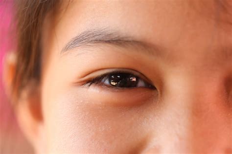 Everything you need to know about Double Eyelid surgery
