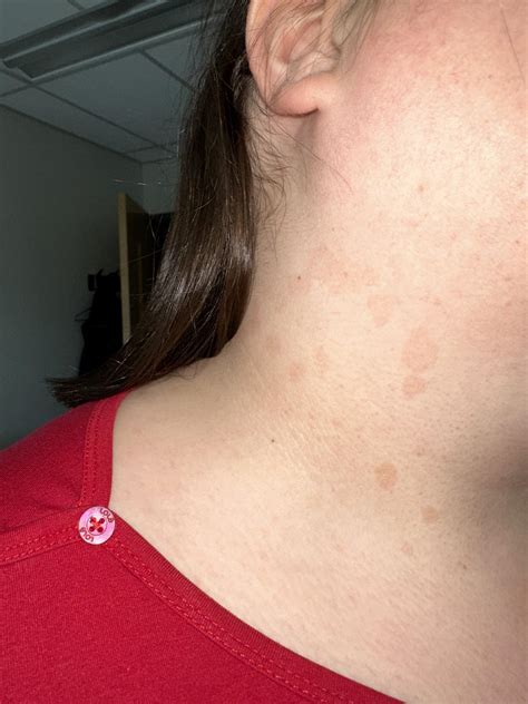 I’ve had these brown spot appear in my neck over the last few weeks.. any idea what it could be ...