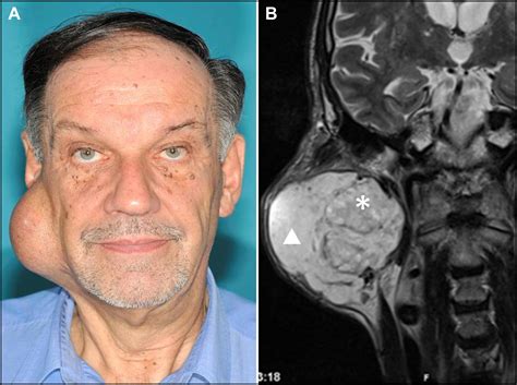 Pleomorphic Adenoma of the Parotid Gland - The American Journal of Medicine