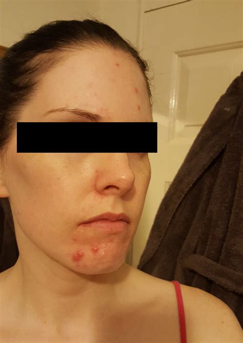 Cystic Acne Chin