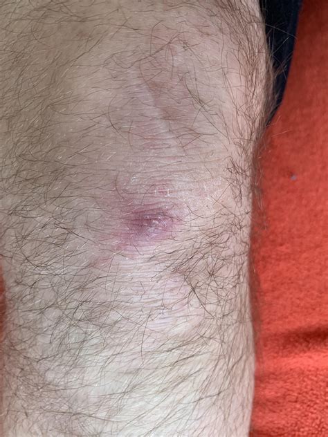 Extremely sensitive bump on my knee. Hard exterior. Not a pimple/zit. Any ideas? : r/injuries