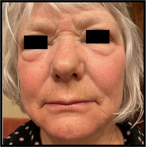 Facial Swelling Secondary to Superior Vena Cava Syndrome - The Journal ...
