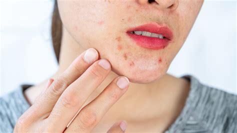 I'm a dermatologist - here is a 3-step acne routine to help your skin ...