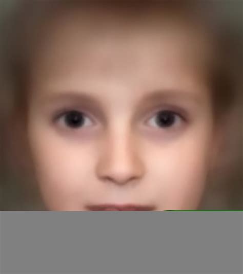 List 90+ Pictures Facial Feature Vascular Ehlers-danlos Syndrome Pictures Sharp