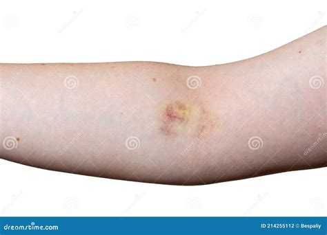 Hand of Man Faceless Elbow with Bruise Damage. Stock Photo - Image of ...