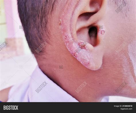 Fungal Infection Treatment In Ear at John Vanness blog