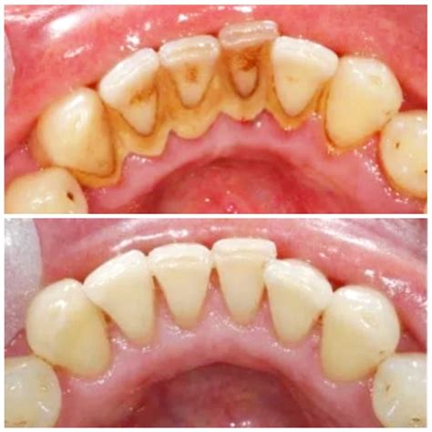 Dental Calculus Pictures at Quyen Elliott blog