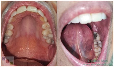 Causes, Symptoms and Treatment of "High-Arched Palate"