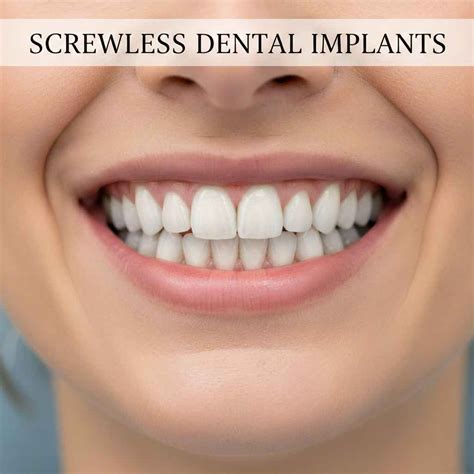 Bicon Dental Implants: A Complete Patient Guide to the Screwless System - Front Dental Implants