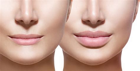 Plastic Surgery Lips Before After | Lipstutorial.org