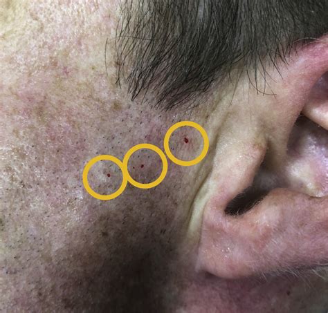 First bite syndrome treated with onabotulinumtoxin A injections - The ...