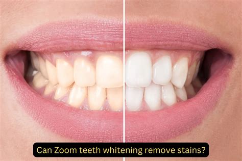 Achieve Brighter Smiles: Zoom Teeth Whitening in Duba