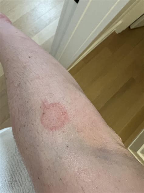 Pityriasis Rosea or Ringworm? : r/PityriasisRosea