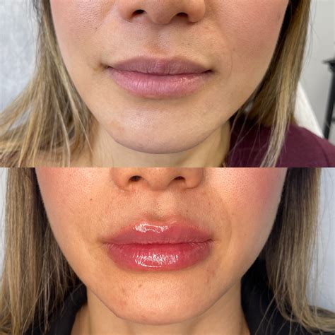 Bad Lip Injections Before And After