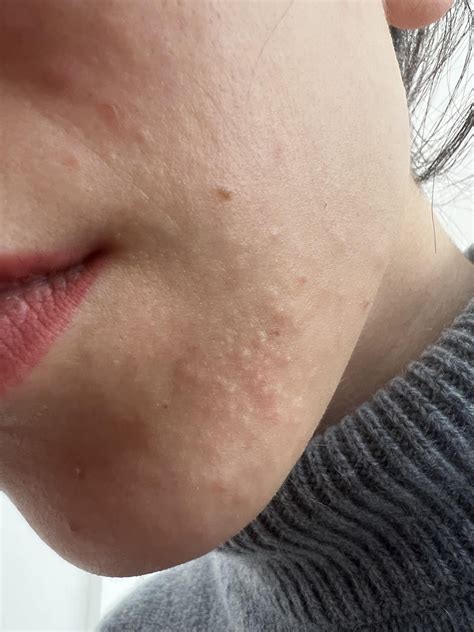 [Acne] white bumps on chin : r/SkincareAddiction