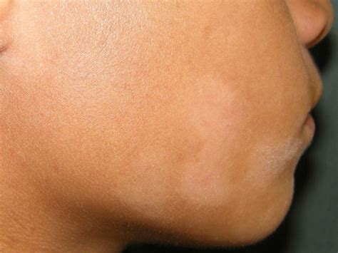 Do White Sun Spots Mean Skin Damage?