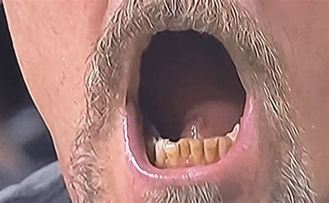 Dan Campbell Teeth