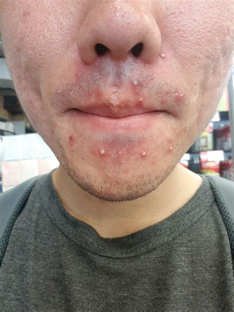 Hormonal Acne Around Mouth