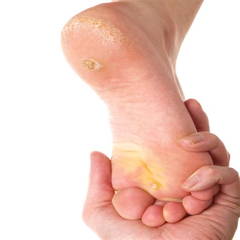 What Causes Corns And Calluses On Feet at Kenneth Keene blog