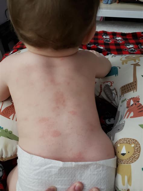 Infant Heat Rash