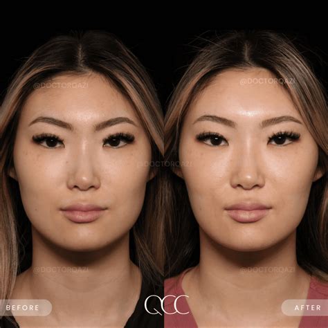 Masseter Muscle Botox