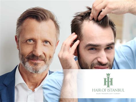 Mature Vs Receding Hairline: What's The Real Difference?