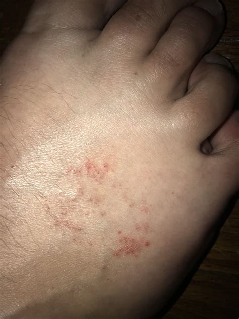 Rash On Top Of Foot That Itches on Sale | emergencydentistry.com