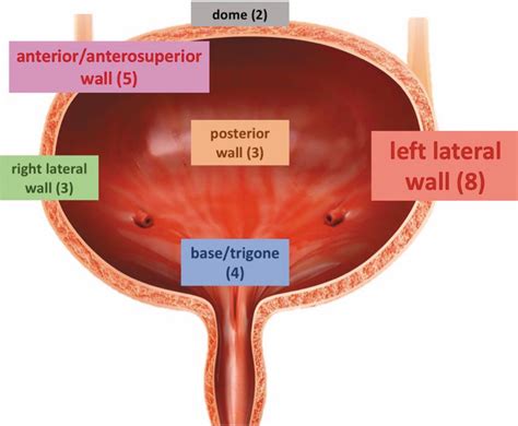Urinary Tract Large Cell Neuroendocrine Carcinoma: Diagnostic, Prognostic and Therapeutic Issues ...