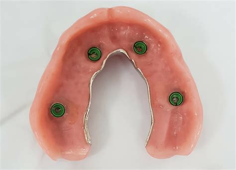 Implant Dentures (Complete)