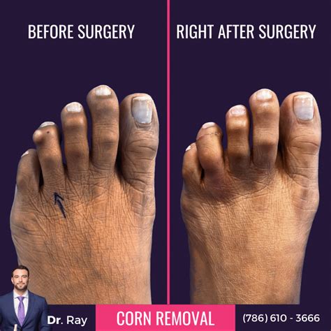 What to Know About Corn Removal Surgery Before And After