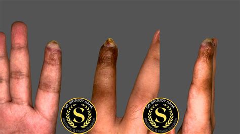 Fingertip Regeneration: How Cutting-Edge Science Brought a Lost Finger ...