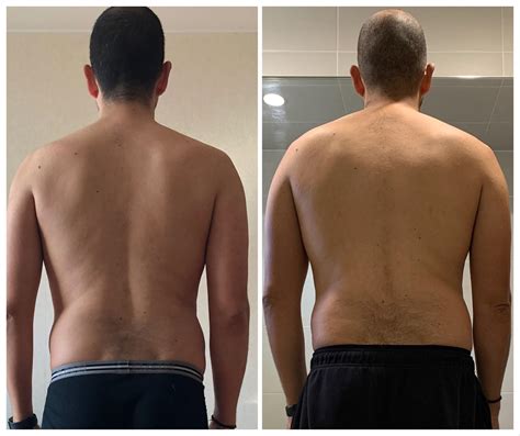 Scoliosis Before And After Yoga