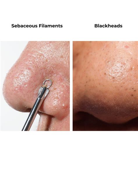 Sebaceous Filaments vs Blackheads, are they the same? – No Face Skincare