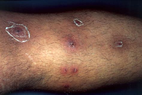 Sebaceous Cyst Vs Cutaneous Abscess Of Abdominal Wall - Infoupdate.org