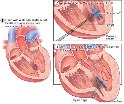 Hybrid Closure of Postinfarction Apical Ventricular Septal Defect Using Septal Occluder Device ...