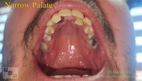 Causes, Symptoms and Treatment of "High-Arched Palate"