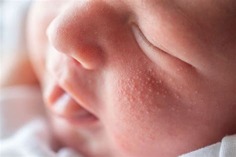 Sarpullido en bebés, aprende a distinguir sus causas | Winny