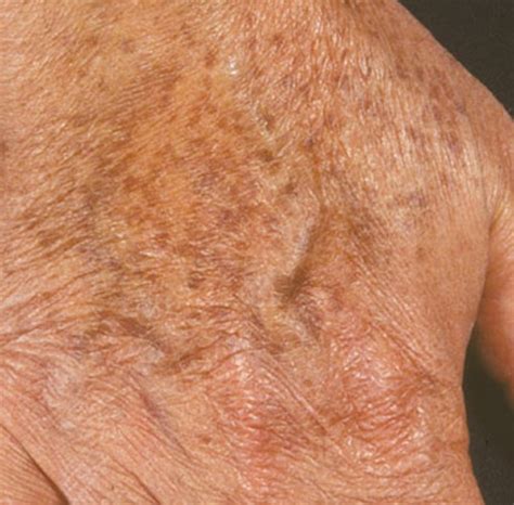 Liver Spots: Causes, Treatments, and Removal Options - YouMeMindBody