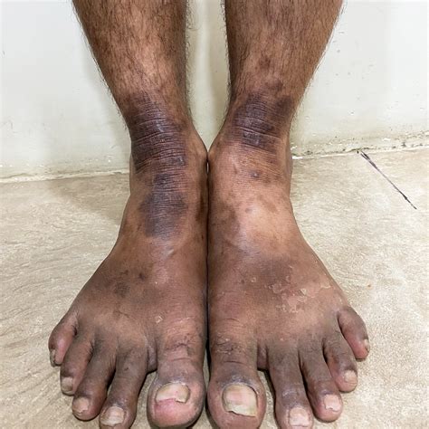 Nummular Eczema vs Ringworm | Symptoms & Treatment Guide