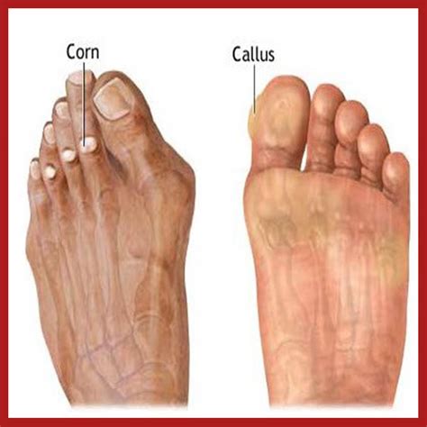 How To Tell Difference Between Corn And Callus at Eric Hopkins blog