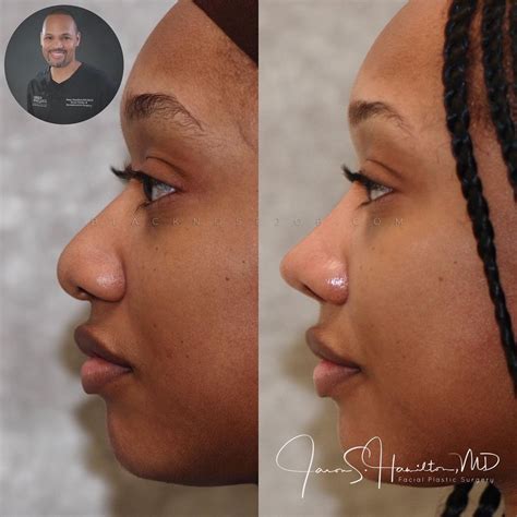 Good Rhinoplasty Before And After