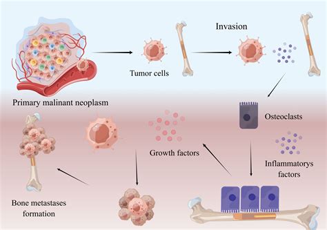 Frontiers | Management of pain in patients with bone metastases