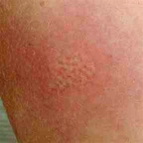 Puss Caterpillar or Asp — General Information | Bugs In The News