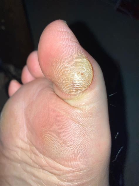 Outside Of Big Toe Callus