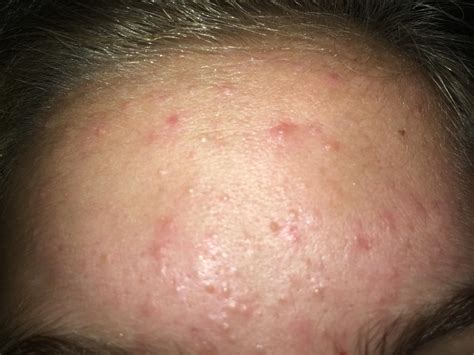 Red Bumps On Face