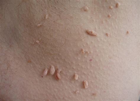 What Is A Skin Tag And How Does It Form at Myron Moses blog