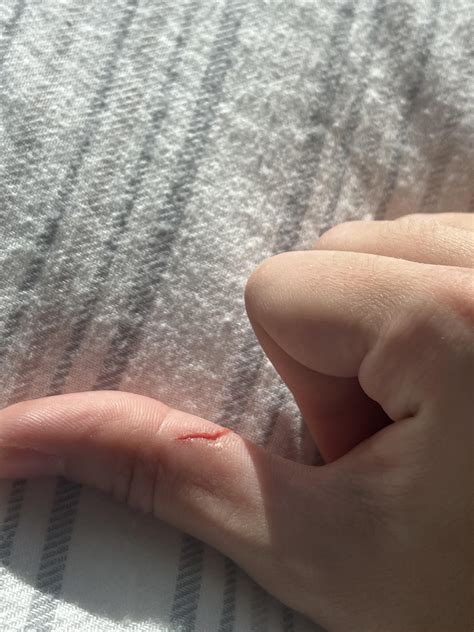 Does this need stitches? Sliced my thumb last night and it didn’t stop bleeding (with pressure ...