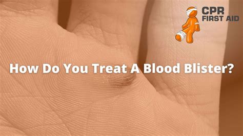 Blood Blister Treatment
