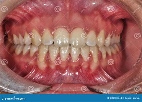 Close-Up of Adult Human Teeth and Gums Stock Photo - Image of oral, care: 330401948