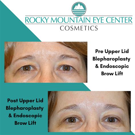 Endoscopic Brow Lift Dubai at Mabel Singer blog